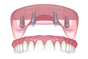 All on 4 Dental Implants